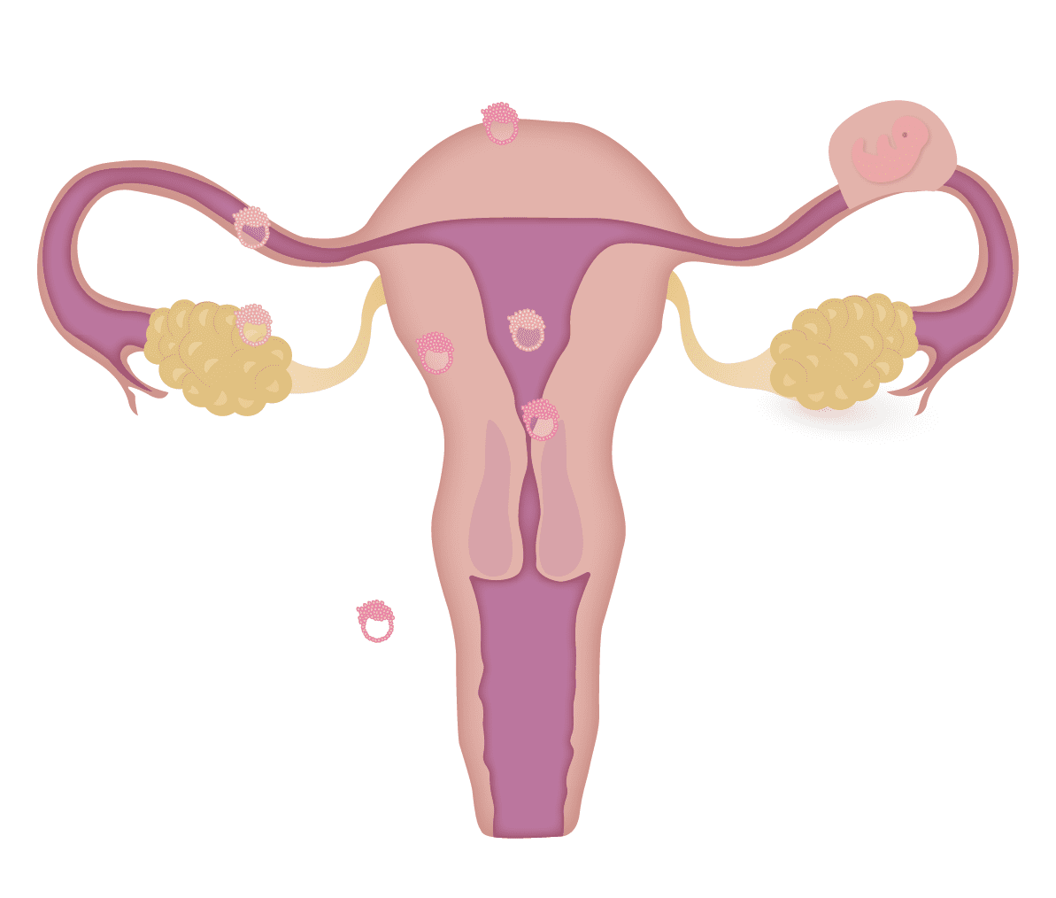 ectopic-pregnancy