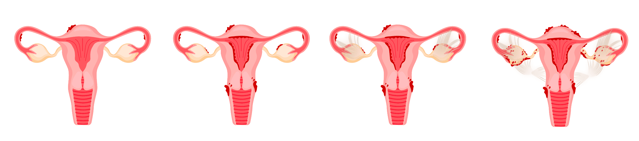 Endometriosis