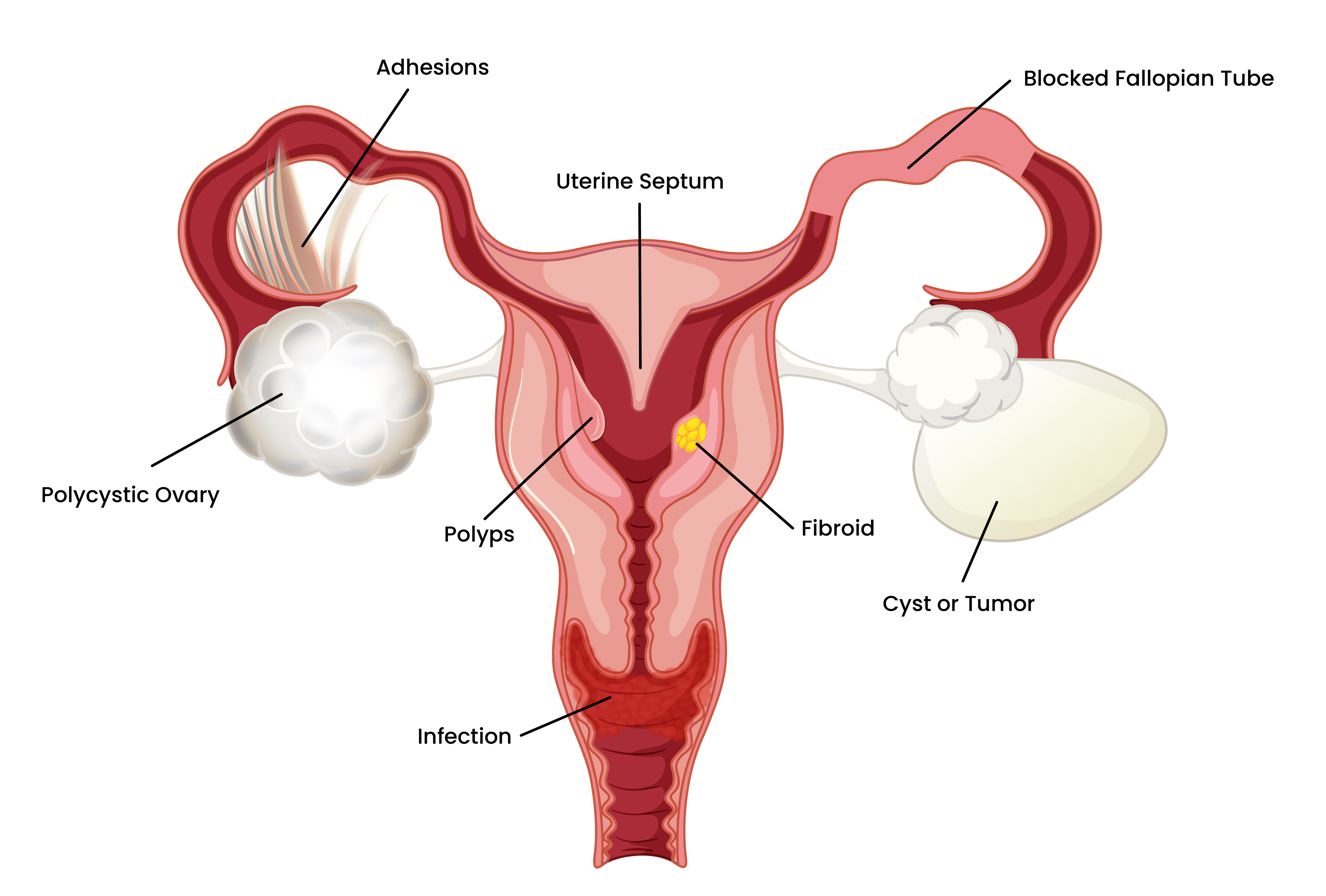 female-infertility-causes