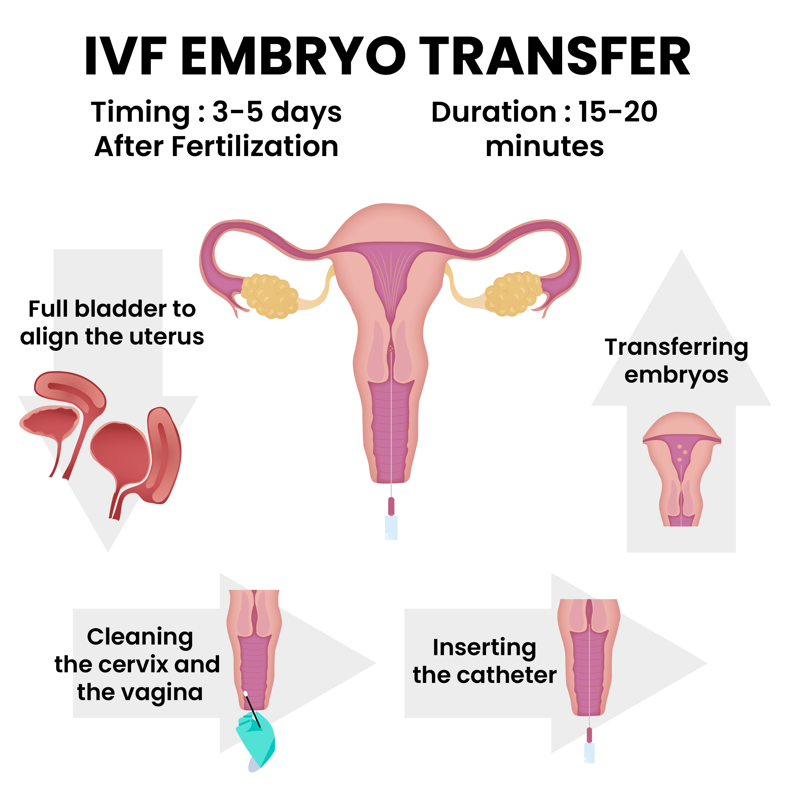 ivf-embryo-transfer.